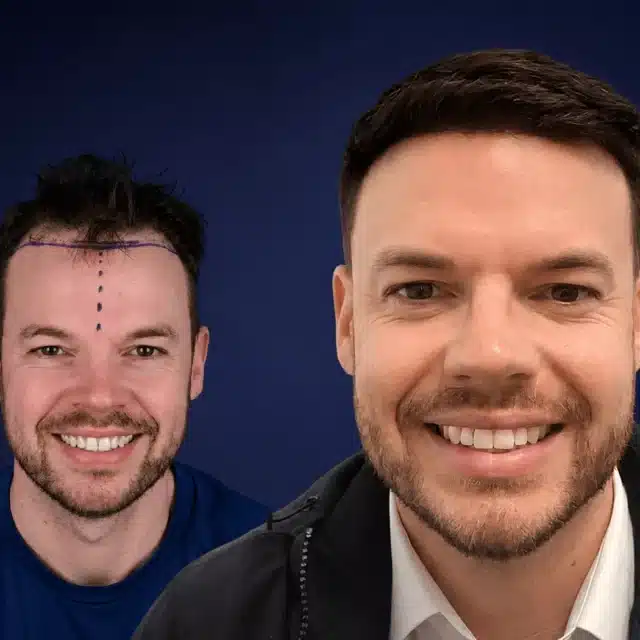 4000-grafts-hair-transplant-before-after-david-j-cosmedica-6a043449d4ff7