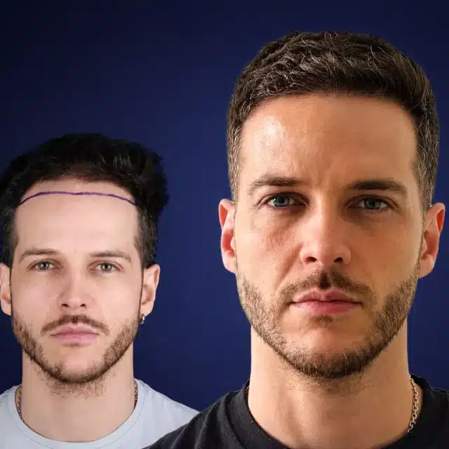 4000-grafts-hair-transplant-before-after-gianni-ds-cosmedica