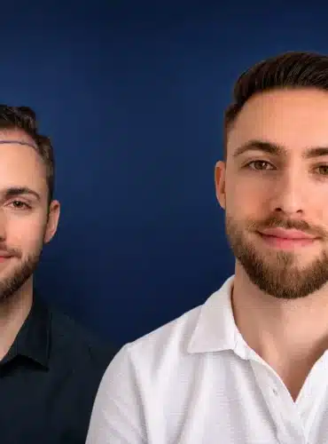 4000-grafts-hair-transplant-before-after-marek-d-cosmedica