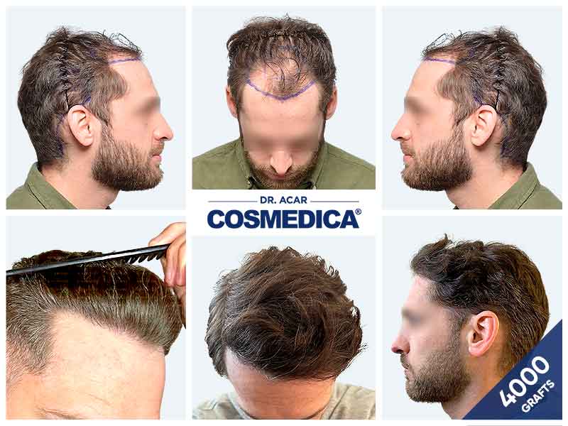 A 4000 graft hair transplant transformation at Cosmedica clinic