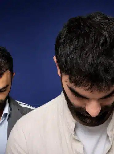 4200-grafts-hair-transplant-before-after-kevin-n-cosmedica
