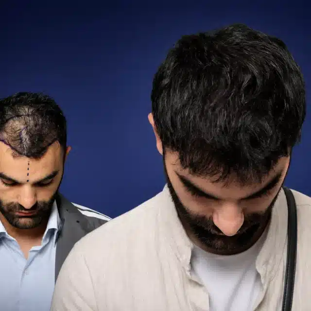 4200-grafts-hair-transplant-before-after-kevin-n-cosmedica