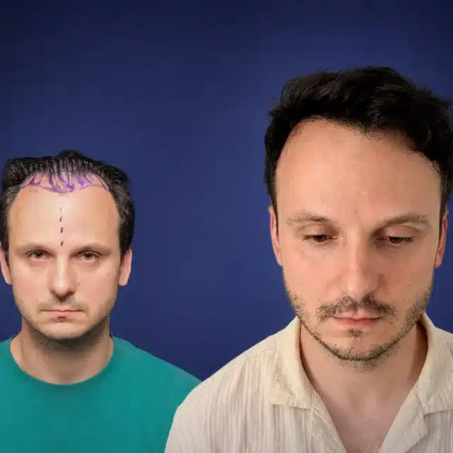 4200-grafts-hair-transplant-before-after-michal-p-cosmedica
