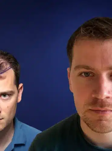 4200-grafts-hair-transplant-before-after-romain-c-cosmedica