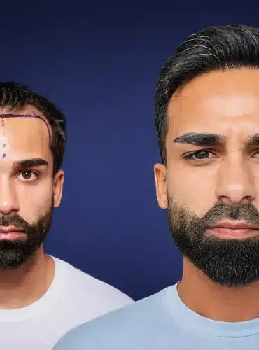 4300-grafts-hair-transplant-before-after-jonathan-m-cosmedica