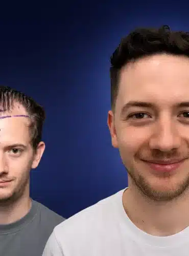 4500-grafts-hair-transplant-before-after-nicolas-j-cosmedica