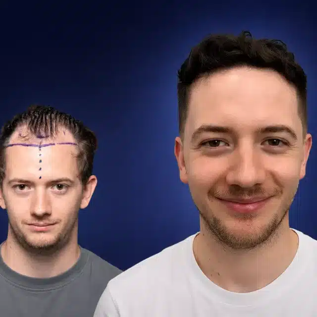 4500-grafts-hair-transplant-before-after-nicolas-j-cosmedica