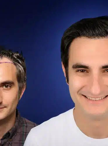 4500-grafts-hair-transplant-before-after-pau-r-cosmedica