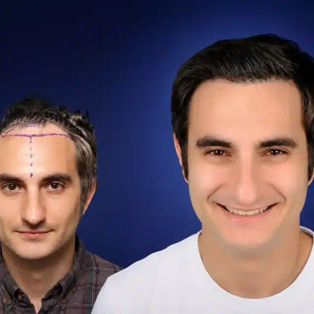 4500-grafts-hair-transplant-before-after-pau-r-cosmedica