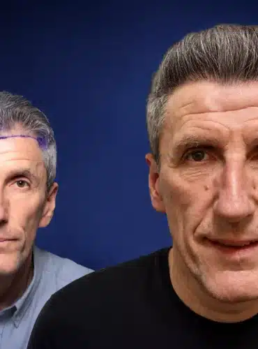 4500-grafts-hair-transplant-before-after-vlad-b-cosmedica
