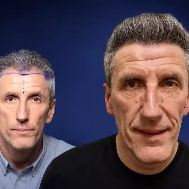 4500-grafts-hair-transplant-before-after-vlad-b-cosmedica