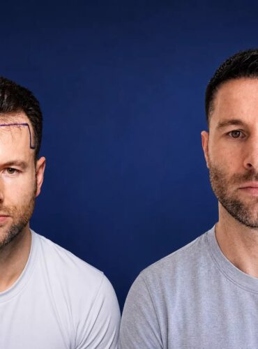 4700-grafts-hair-transplant-before-after-1498x1050