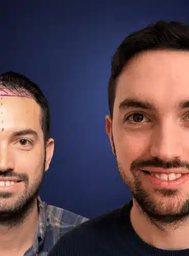 4800-grafts-hair-transplant-before-after-alex-g-cosmedica-6a0434483c794