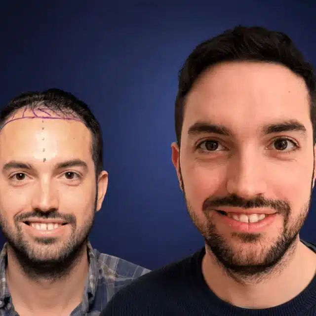 4800-grafts-hair-transplant-before-after-alex-g-cosmedica-6a0434483c794