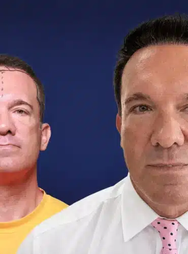4900-grafts-hair-transplant-before-after-alfred-t-cosmedica-6a043448179ce