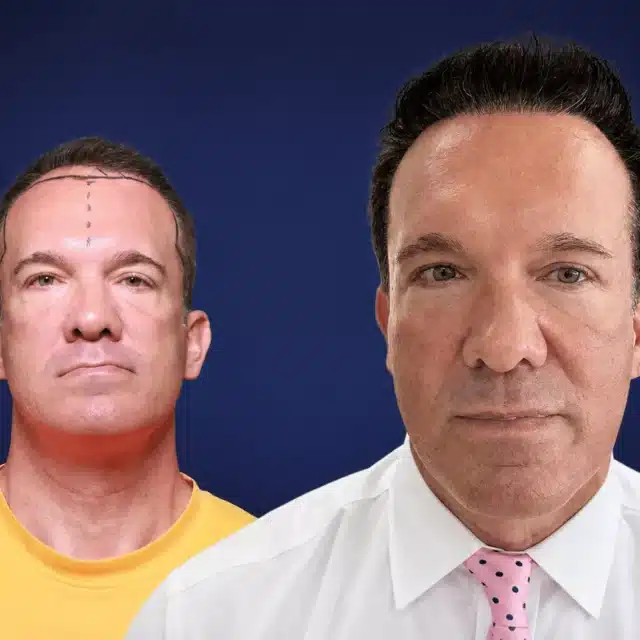 4900-grafts-hair-transplant-before-after-alfred-t-cosmedica-6a043448179ce