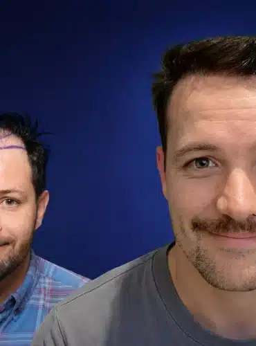 4900-grafts-hair-transplant-before-after-paul-c-cosmedica