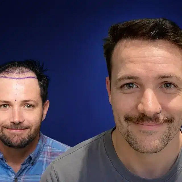 4900-grafts-hair-transplant-before-after-paul-c-cosmedica