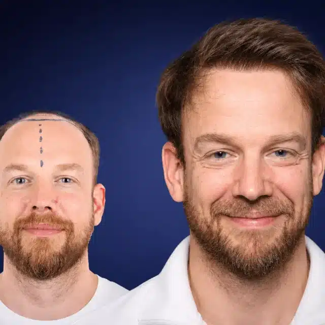 5000-grafts-hair-transplant-before-after-david-s-cosmedica-6a04344984945