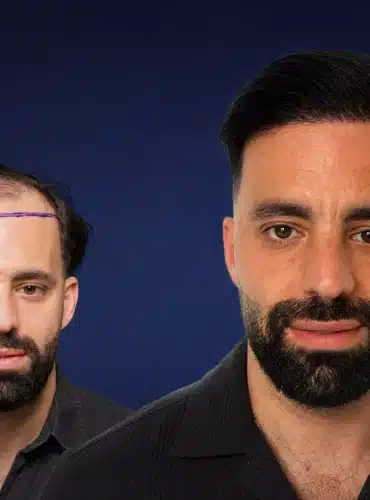 5000-grafts-hair-transplant-before-after-kevin-saporito-cosmedica