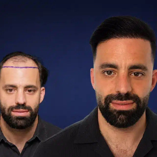 5000-grafts-hair-transplant-before-after-kevin-saporito-cosmedica