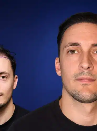 5200-grafts-hair-transplant-before-after-virgile-m-cosmedica