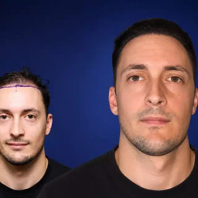 5200-grafts-hair-transplant-before-after-virgile-m-cosmedica