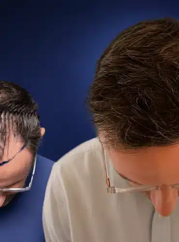 5500-grafts-hair-transplant-before-after-chris-h-cosmedica-6a043447694bf