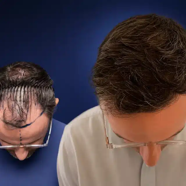 5500-grafts-hair-transplant-before-after-chris-h-cosmedica-6a043447694bf