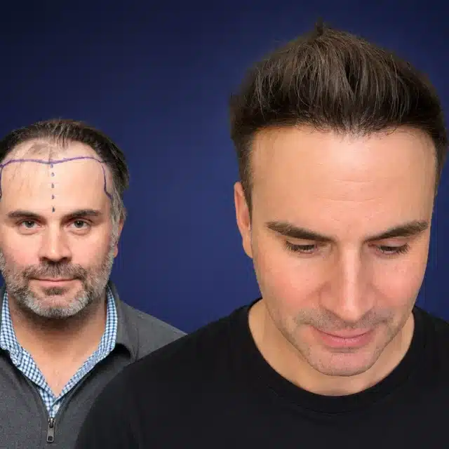 5500-grafts-hair-transplant-before-after-erik-p-cosmedica