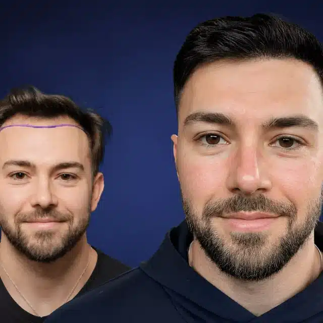 5600-grafts-hair-transplant-before-after-connor-w-cosmedica-6a0434475cfdd