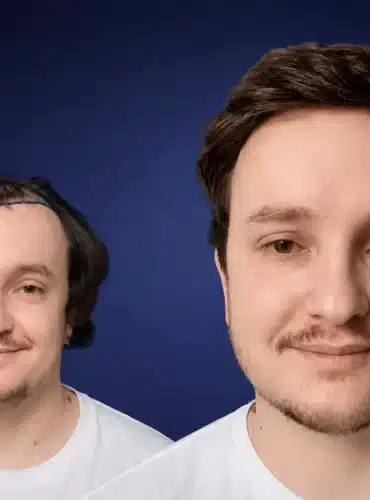 5600-grafts-hair-transplant-before-after-declan-p-cosmedica-6a04344929a42