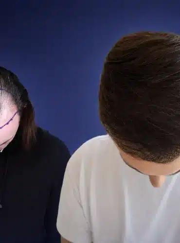 5600-grafts-hair-transplant-before-after-mathias-m-cosmedica