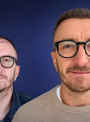 5800-grafts-hair-transplant-before-after-zoran-t-cosmedica