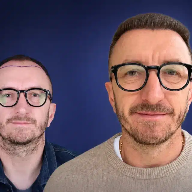5800-grafts-hair-transplant-before-after-zoran-t-cosmedica