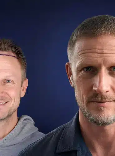 6000-grafts-hair-transplant-before-after-johnny-k-cosmedica