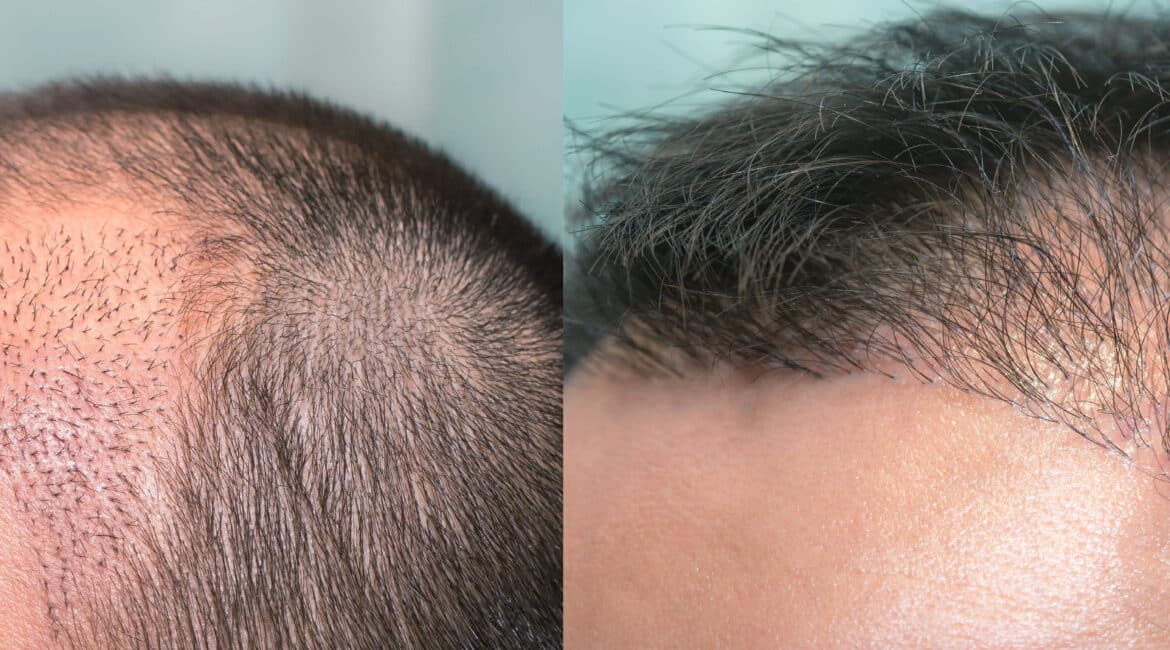 Hair transplant after 20 days can show early hairline healing, with some shedding and regrowth changes still expected