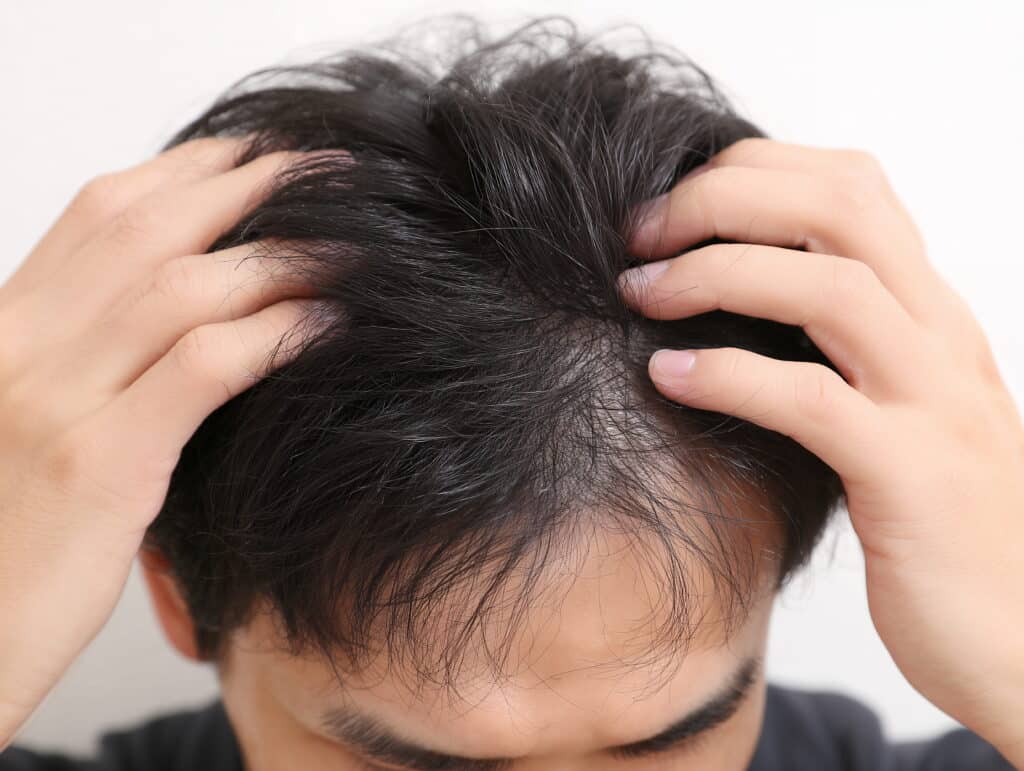 Hair transplant after 20 days may show temporary shedding as the follicles enter the recovery phase