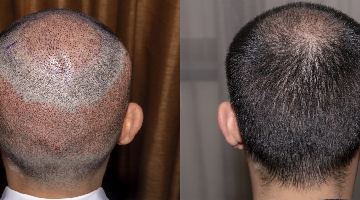 7 days after hair transplant showing donor area healing and early hair growth