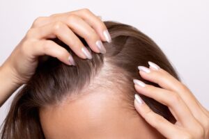 L'attaccatura capelli di una donna