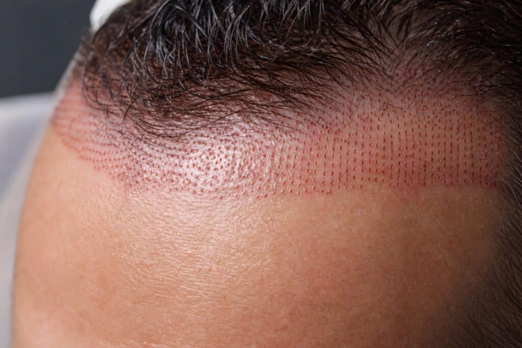 Ligne frontale en cicatrisation après une greffe de cheveux après 15 jours
