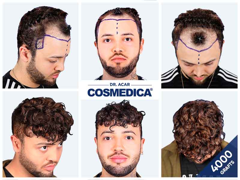 Coverage from 4000 grafts hair transplant at Cosmedica Clinic