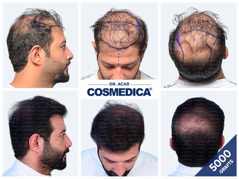 5000 graft hair transplant showing natural hairline restoration and improved coverage