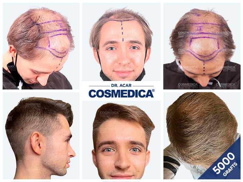 Résultat d’une greffe de cheveux 5000 greffons avec reconstruction complète de la ligne frontale
