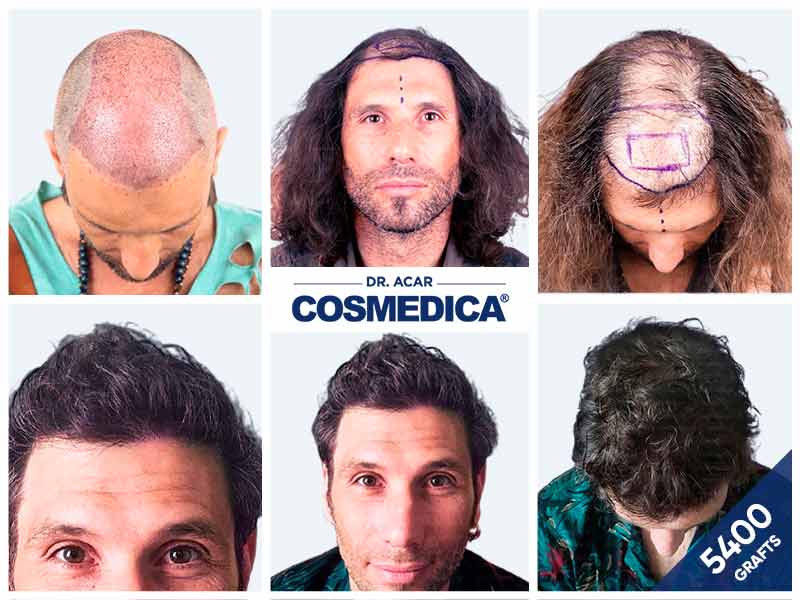 Avant après d’une greffe de cheveux 5000 greffons avec couverture complète