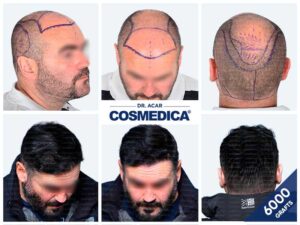 Avant après d’une greffe de cheveux 6000 greffons montrant la reconstruction de la ligne frontale, du dessus du crâne et de la couronne.