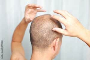 Uomo si tocca la testa preoccupato sia affetto da shock loss ai capelli