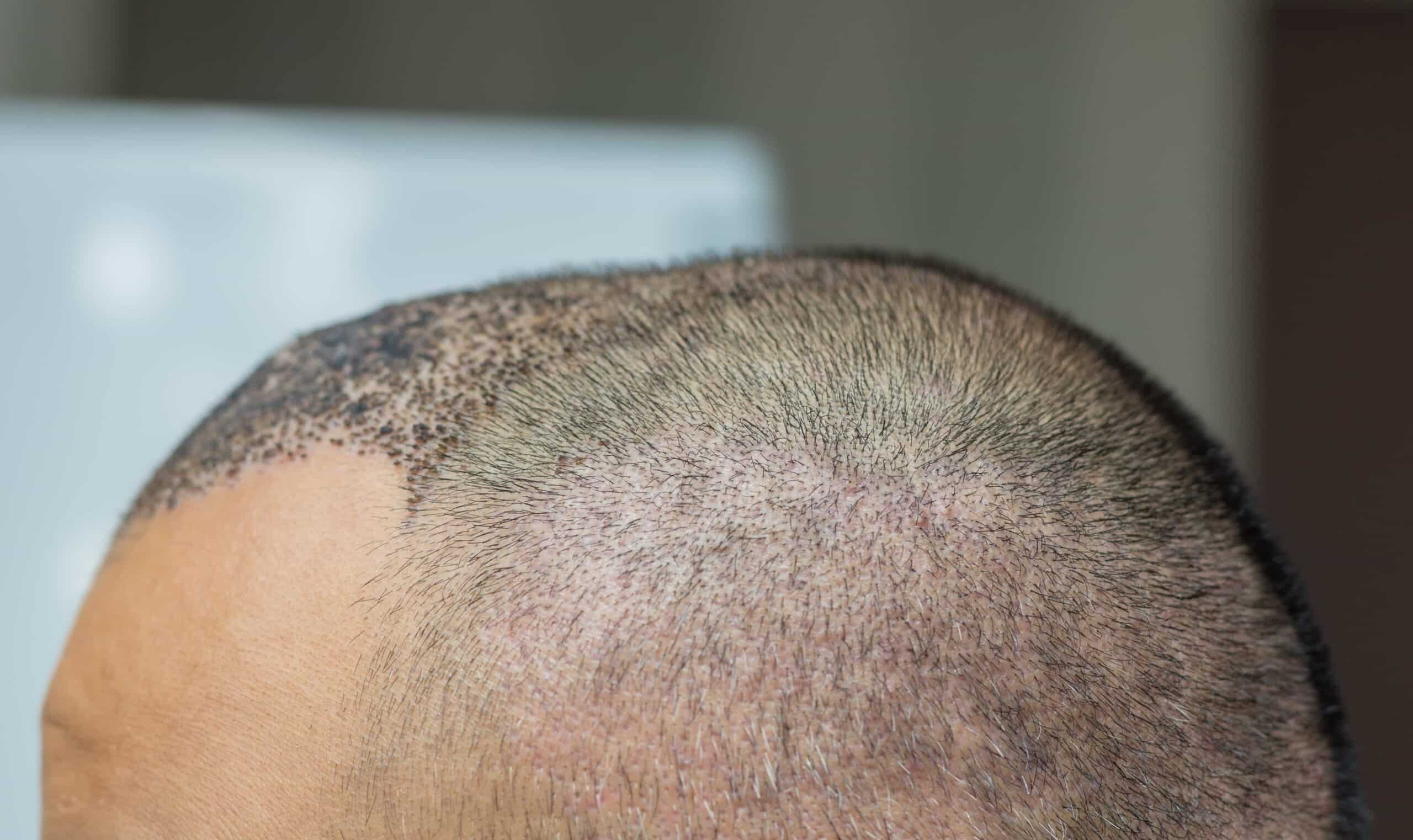 Hair growth after 3 weeks of hair transplantation