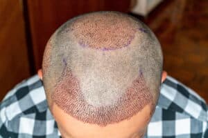 Le shock loss après une greffe de cheveux après 1 mois est une étape normale avant la repousse