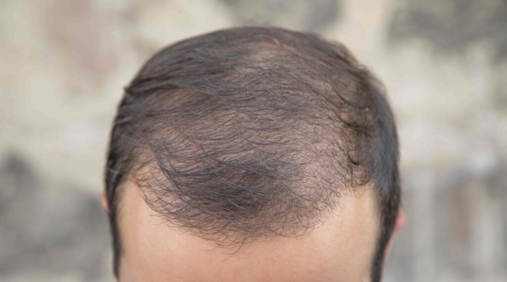 repousse des cheveux 6 mois après une greffe capillaire